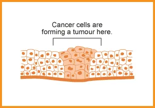  Cancer tumour